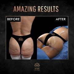 Gluteoplastia, (BBL) - Vive Plastic Surgery