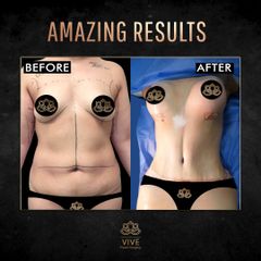 Mommy Makeover - Vive Plastic Surgery