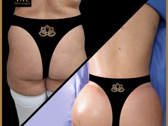 Gluteoplastia antes y después - 874355