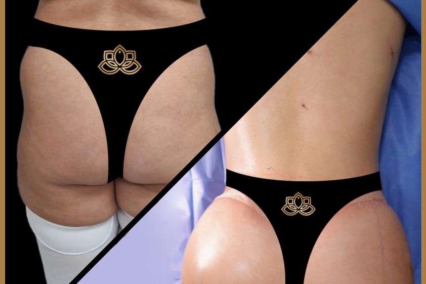 Gluteoplastia antes y después - 874355