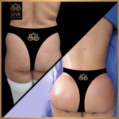 Gluteoplastia (BBL) - Vive Plastic Surgery