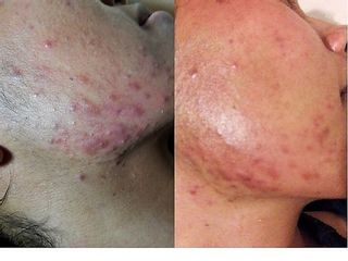 Antes y después de Tratamientos para pieles acnéicas y secuelas 