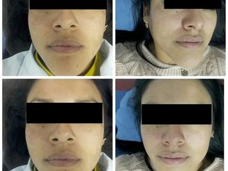 Microdermoabrasión antes y después - 607333