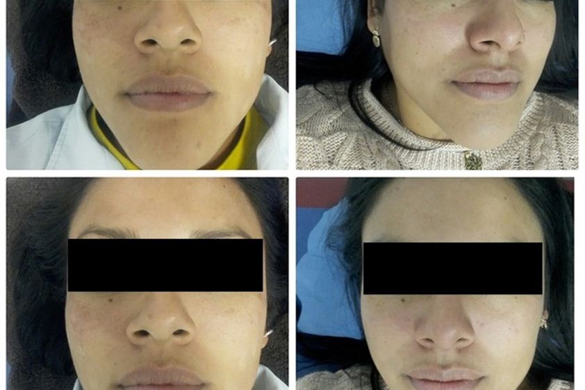 Microdermoabrasión antes y después - 607333