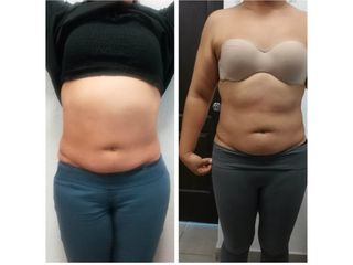 Antes y después de Lipoenzimas