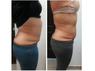 Antes y después de Liposucción