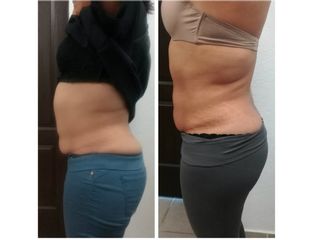 Antes y después de Liposucción