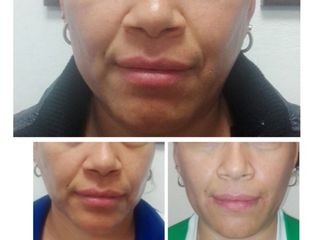 Antes y después de Rejuvenecimiento facial trifase