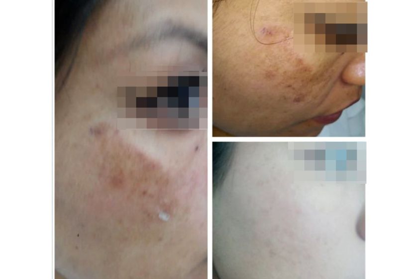 Tratamiento antiacné antes y después - 640116