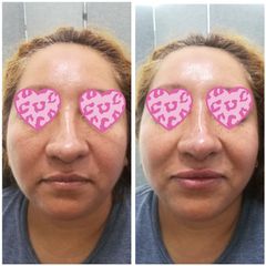 Antes y después de Rejuvenecimiento facial sin perder armonía natural