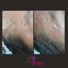 Antes y después de Tratamiento antiacné 