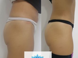 Tratamientos anticelulíticos antes y después - 799080
