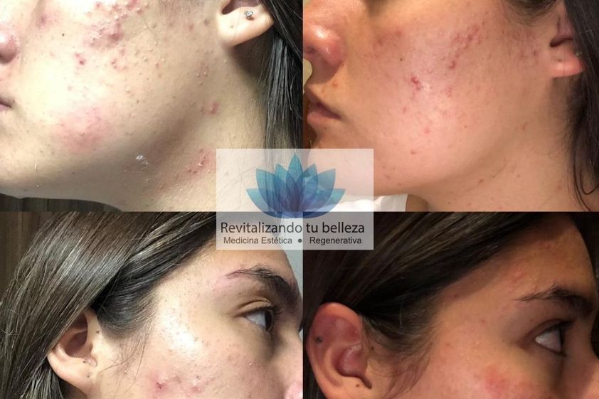 Tratamiento antiacné antes y después - 799082