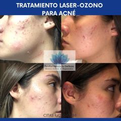 Antes y después de manejo de acné con láser y ozono