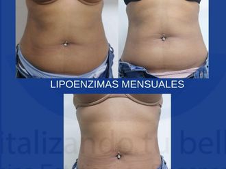 Lipólisis antes y después - 799083