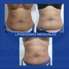Antes y después de Lipoenzimas mensuales