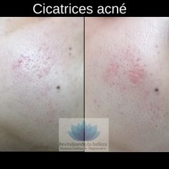 Antes y después de Cicatrices de acné 