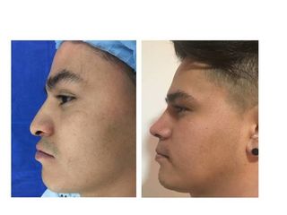 Antes y después de Rinoseptoplastia funcional. Deformidad nasal postraumatica