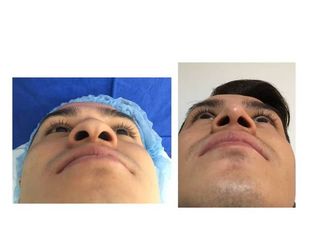 Antes y después de Rinoseptoplastia funcional. Deformidad nasal postraumatica