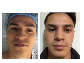 Antes y después de Rinoseptoplastia funcional. Deformidad nasal postraumatica