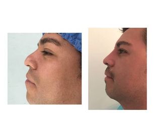 Antes y después de Rinoplastia