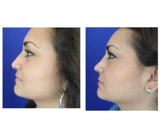 Antes y después de Rinoplastia Funcional