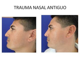 Antes y después de Rinoplastia