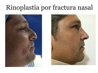 Antes y después de rinoplastia por fractura nasal 0