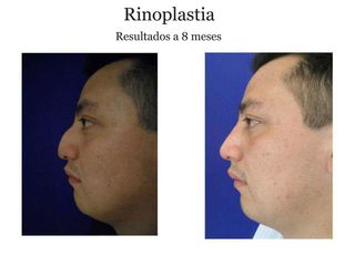 Antes y después de rinoplastia (resultados a 8 meses)