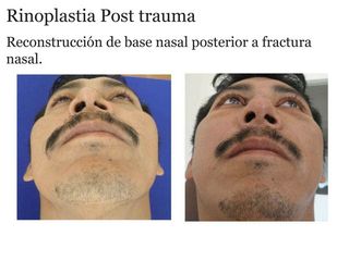 Antes y después de rinoplastia post trauma 1