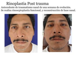 Antes y después de rinoplastia post trauma