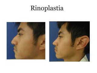 Antes y después de rinoplastia