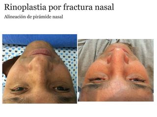 Antes y después de rinoplastia por fractura nasal 1