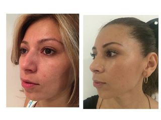 Antes y después de Rinoplastia (Acortamiento nasal)