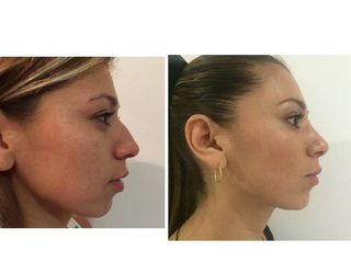 Antes y después de Rinoplastia (Acortamiento nasal)