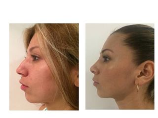 Antes y después de Rinoplastia (Acortamiento nasal)