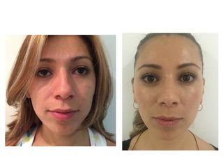 Antes y después de Rinoplastia (acortamiento nasal )