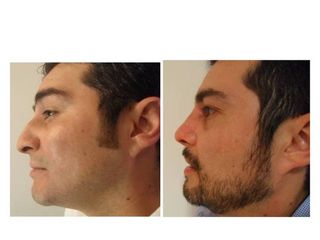 Antes y después de Rinoplastia evolución 12 meses