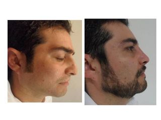 Antes y después de Rinoplastia evolución 12 meses