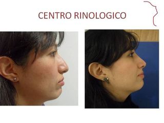 Antes y después de  Rinoplastia (acortamiento nasal)