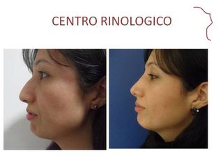 Antes y después de Rinoplastia (acortamiento nasal)