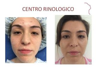 Antes y después de Rinoplastia