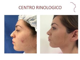 Antes y después de Rinoplastia