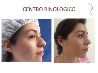 Antes y después de Rinoplastia