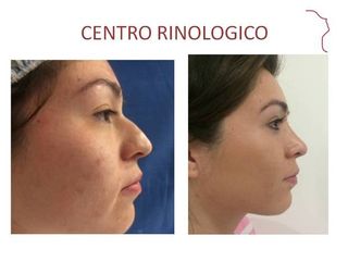 Antes y después de Rinoplastia