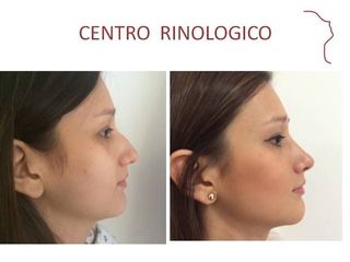 Antes y después de Rinoplastia