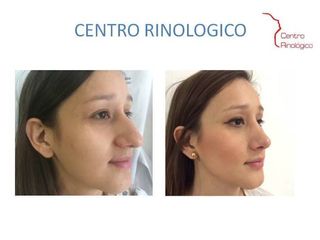 Antes y después de Rinoplastia