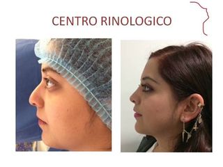 Antes y después de Rinoplastia