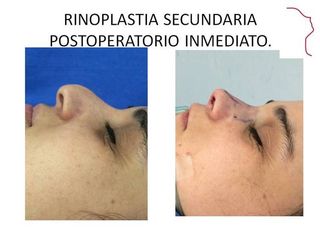 Antes y después de RINOPLASTIA SECUNDARIA.