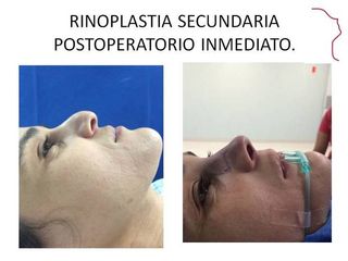 Antes y después de Rinoplastia secundaria